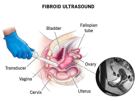 Diagnosis and Investigations of Uterine Fibroids.