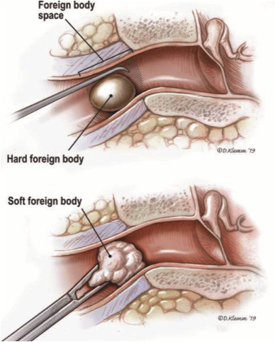 FOREIGN BODY IN THE EAR AND NOSE A foreign body refers to any object that is not naturally present in a specific area of the body. Foreign bodies can be objects that are accidentally inserted or lodged in these areas, causing discomfort, obstruction, and potential complications.