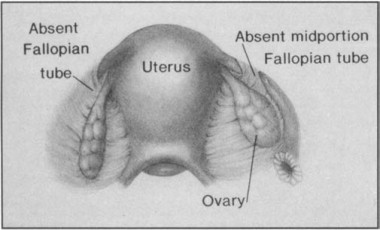 Fallopian Tube Agenesis