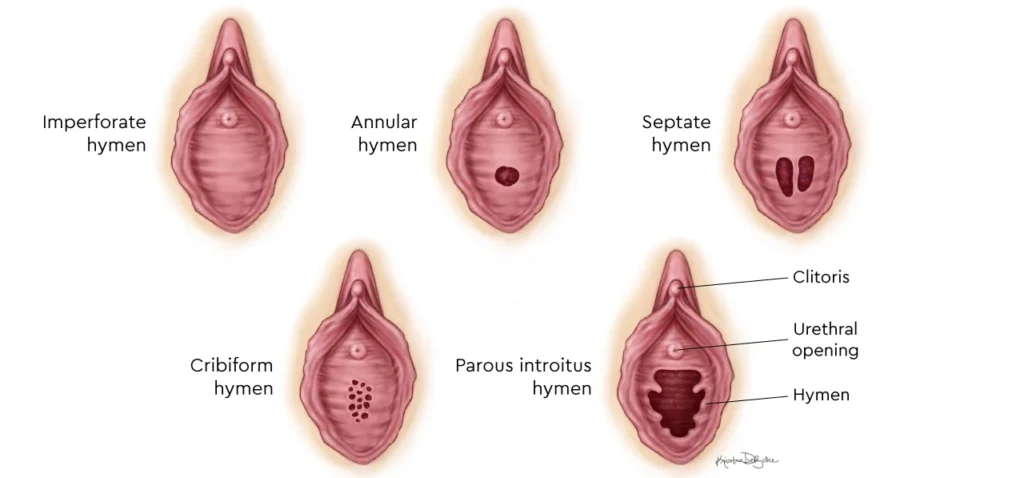 Imperforate Hymen types