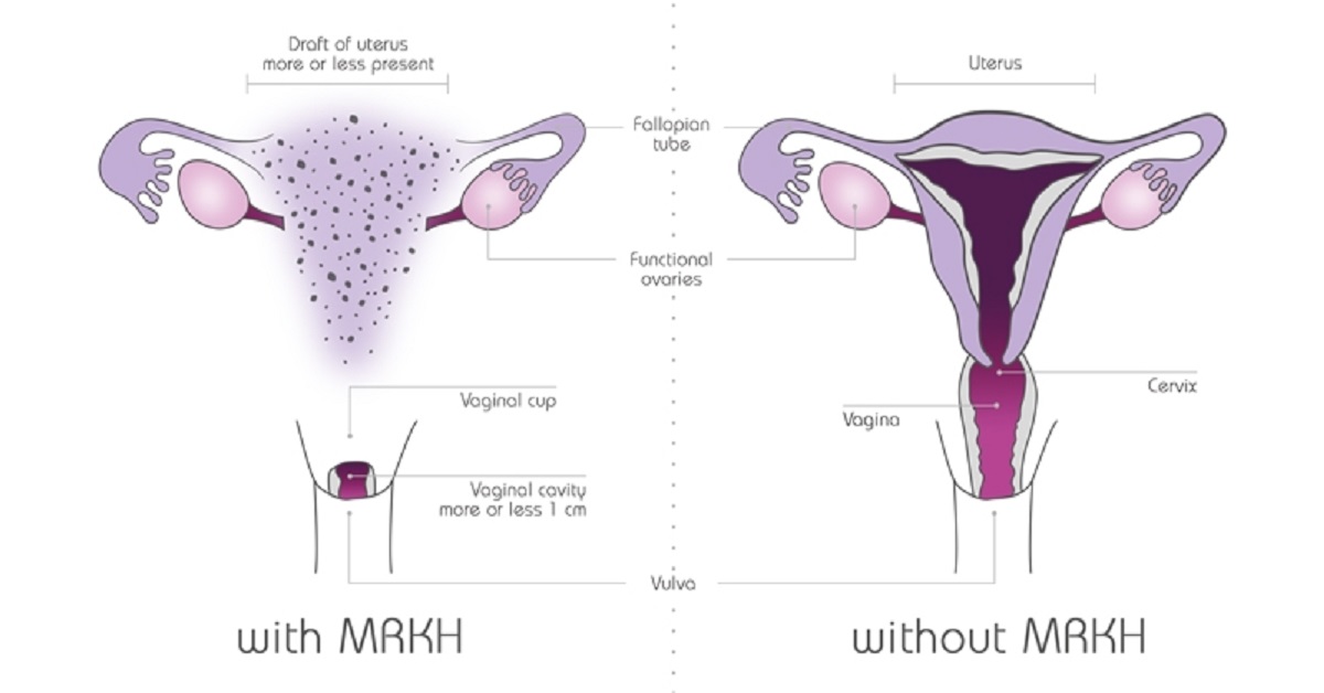 Mayer-Rokitansky-Küster-Hauser (MRKH) syndrome