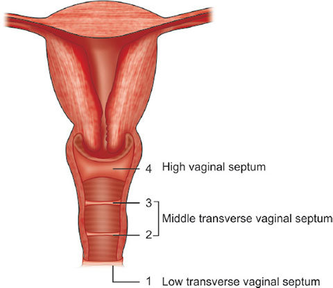 Transverse Vaginal Septum