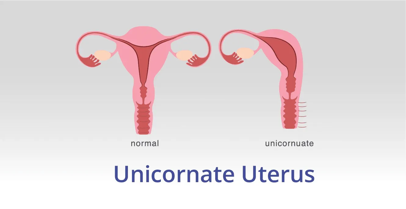 Unicornuate Uterus