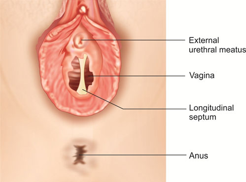 Vertical or Complete Vaginal Septum