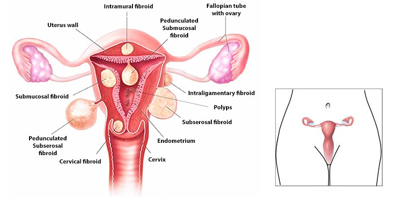 Fibroids are non-cancerous growths in the muscle layer of your uterus (womb). Fibroids are very common. They are also known as myomas. Fibroids can vary in size, from being tiny to being the size of a melon.