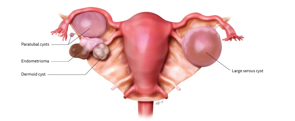 Ovarian Cysts