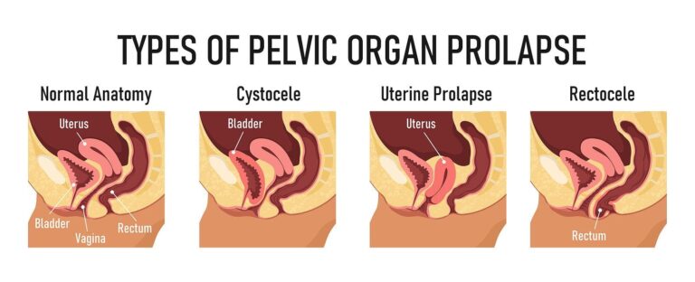 Pelvic Organ Prolapse (POP)