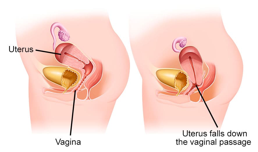 Prolapse of the Uterus