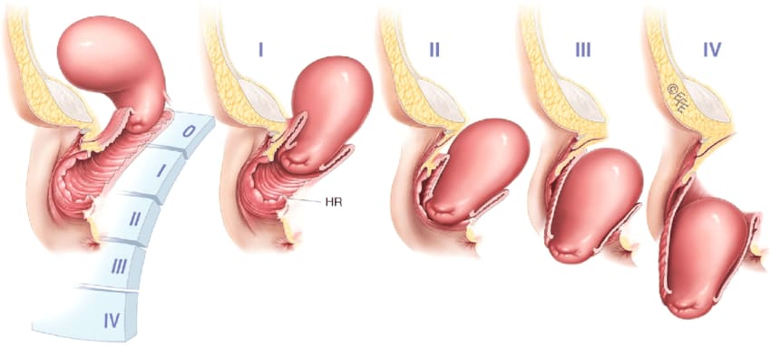 Pelvic Organ Prolapse POP Nurses Revision Pelvic Organ Prolapse POP Nurses Revision