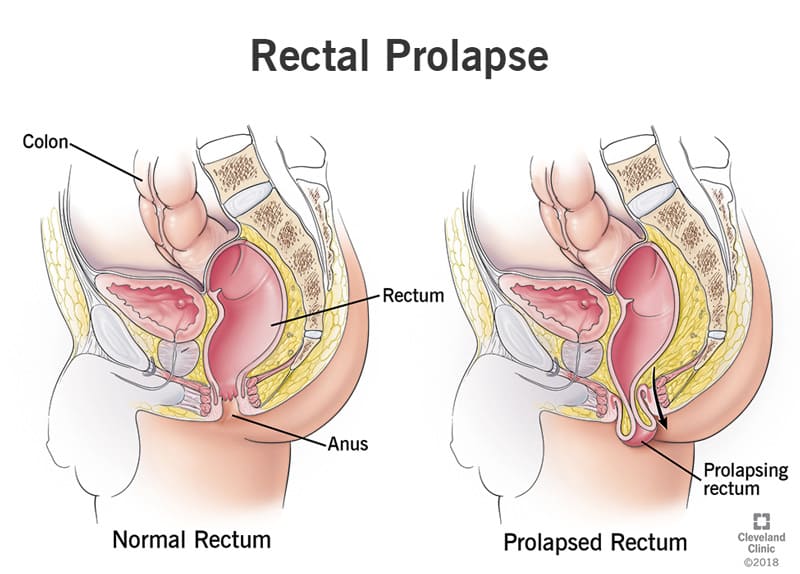 Rectal Prolapse