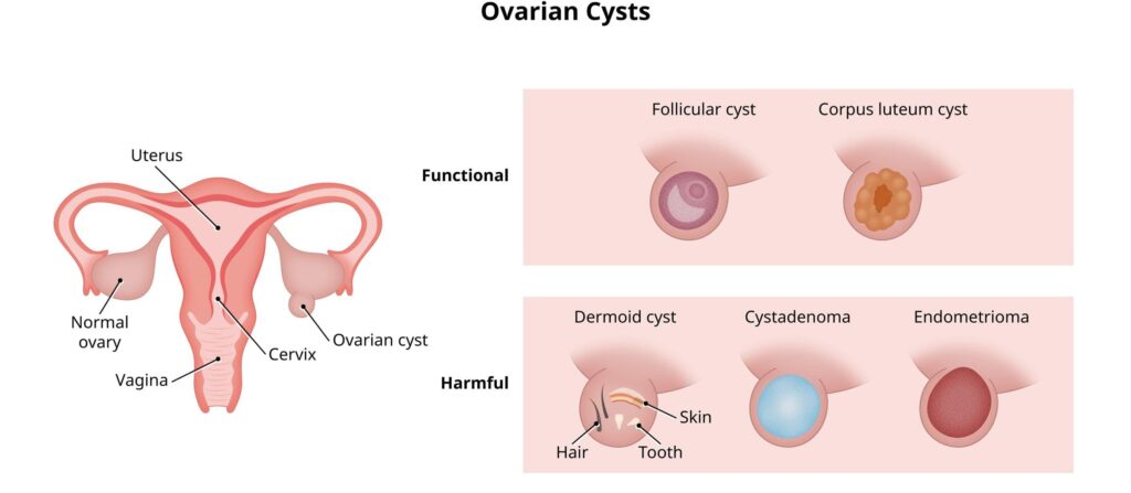 Types of Ovarian Cysts