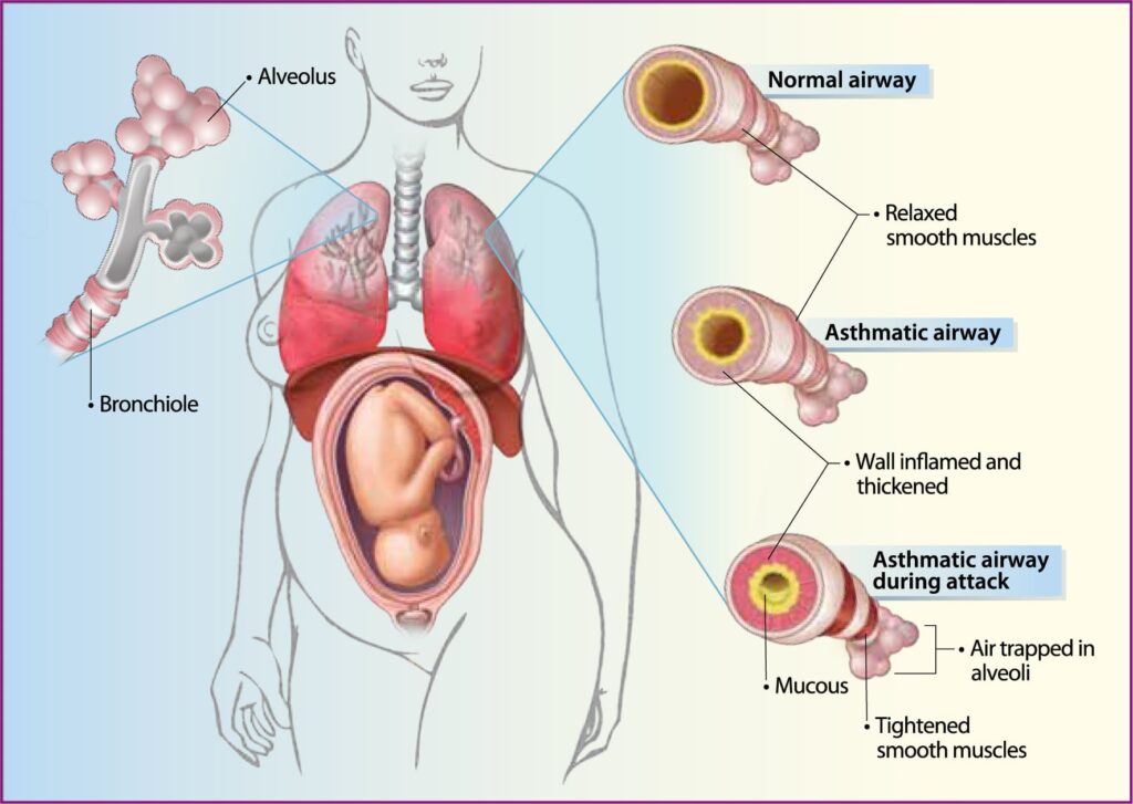 ASTHMA IN PREGNANCY