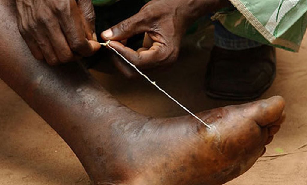 Dracunculosis (Guinea worm)