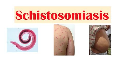 Schistosomiasis