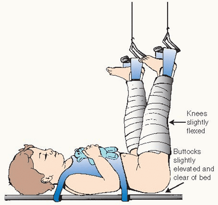 Gallows Traction(Bryant’s Traction) (1)