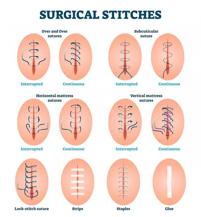 Types of Sutures