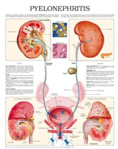 PYELONEPHRITIS - Nurses Revision