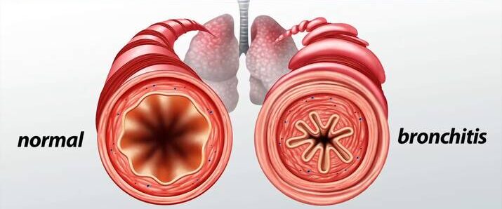 BRONCHITIS