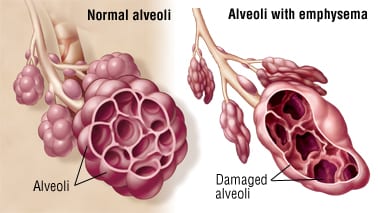 EMPHYSEMA / PULMONARY EMPHYSEMA