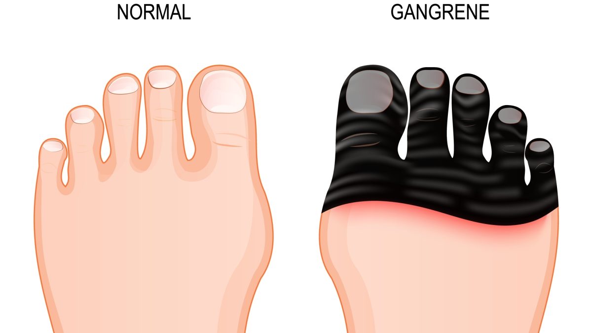 GANGRENE