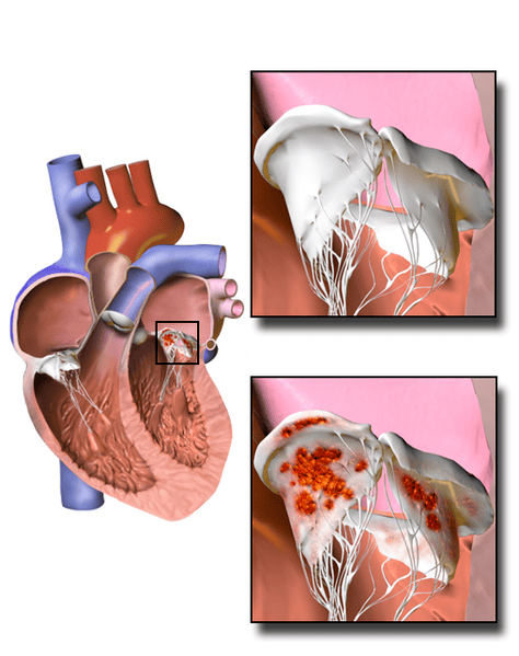 INFECTIVE ENDOCARDITIS, Causes, Investigations, Management, and Nursing Interventions