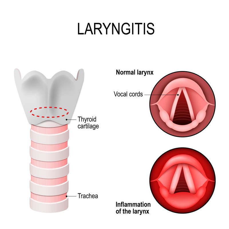 LARYNGITIS