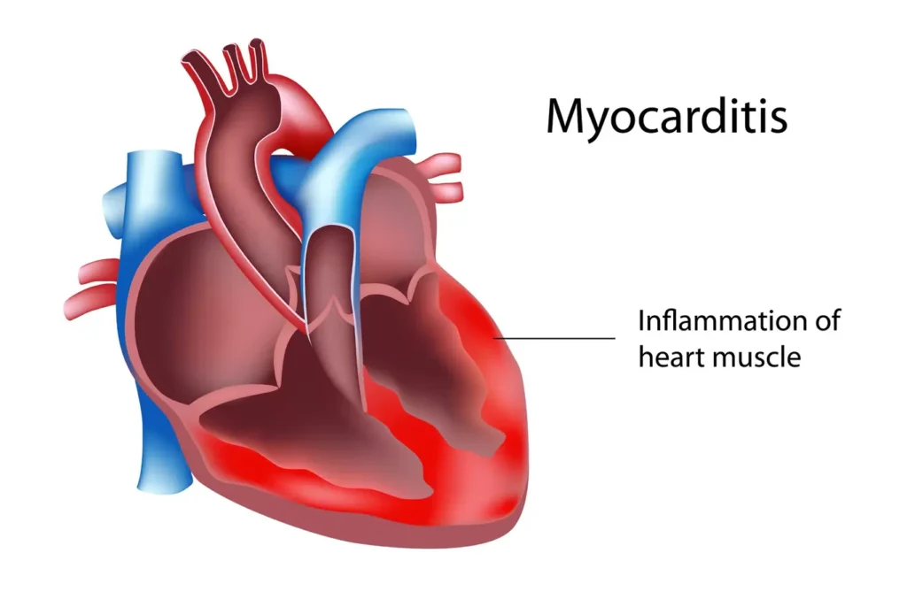MYOCARDITIS: Causes, Investigations, Management, and Nursing Interventions