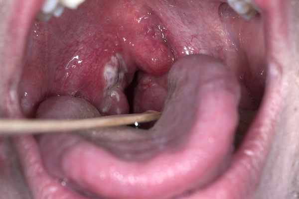 PHARYNGITIS