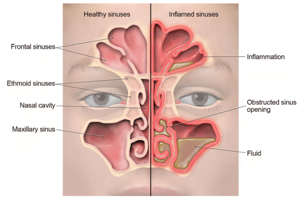 SINUSITIS RHINOSINUSITIS