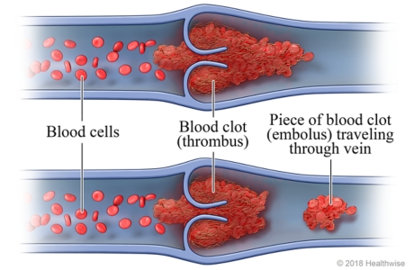 Thrombus and Embolus