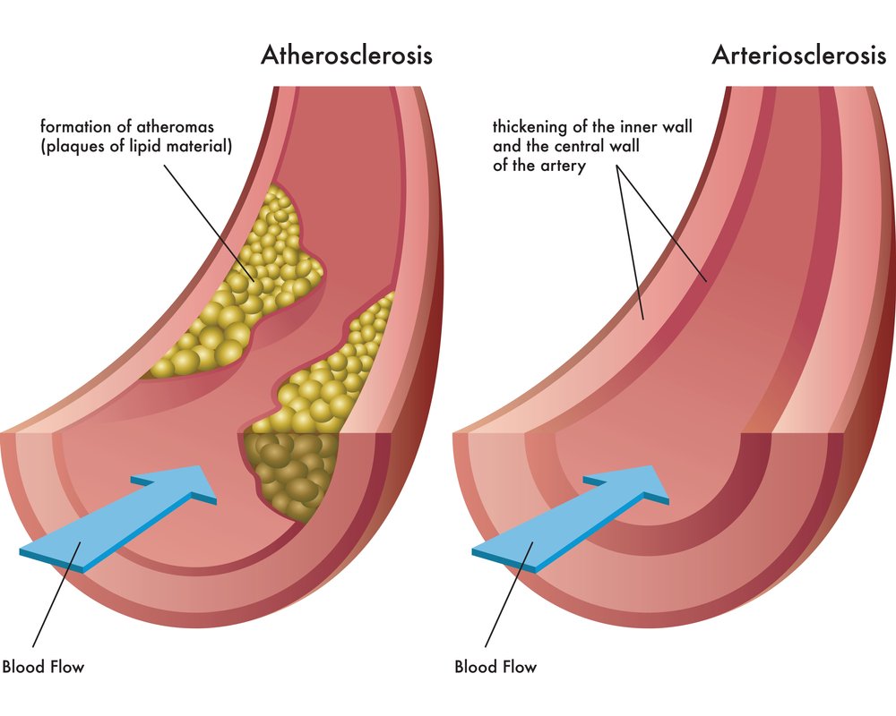 Arteriosclerosis and Atherosclerosis