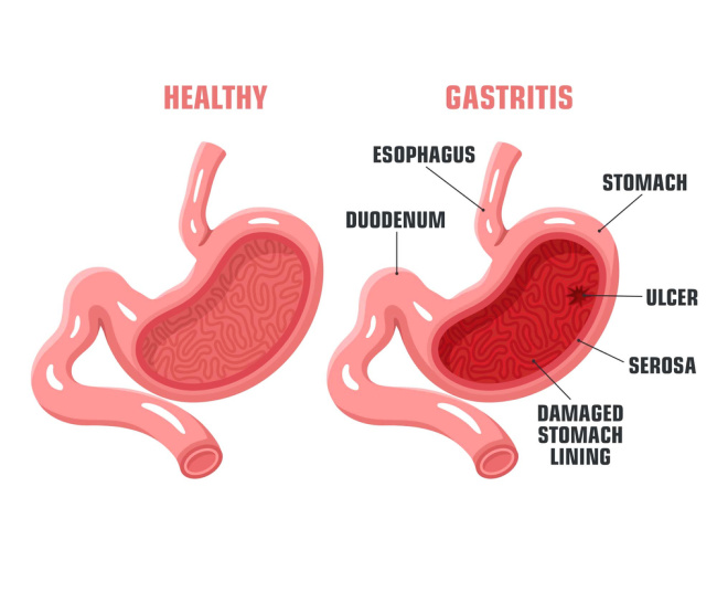 Gastritis Lecture Notes