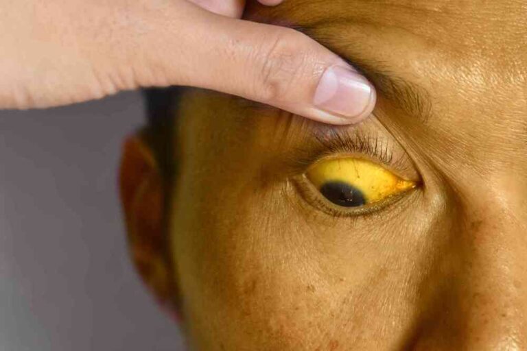 JAUNDICE (Hyperbilirubinemia) (1)