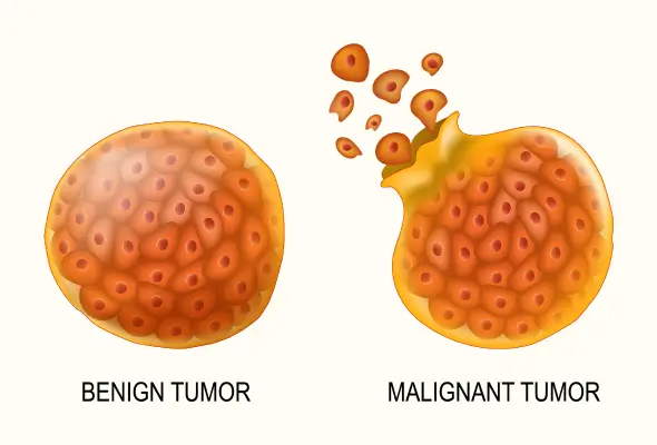TUMORS (NEOPLASMS)