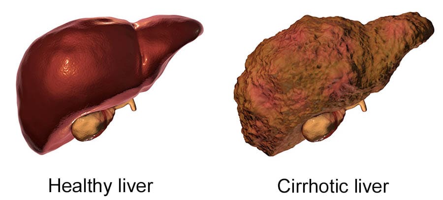 liver cirrhosis