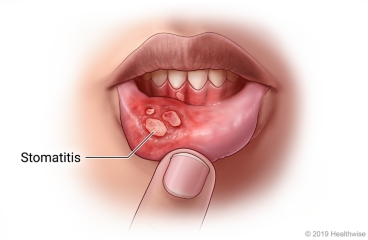 Stomatitis lecture notes