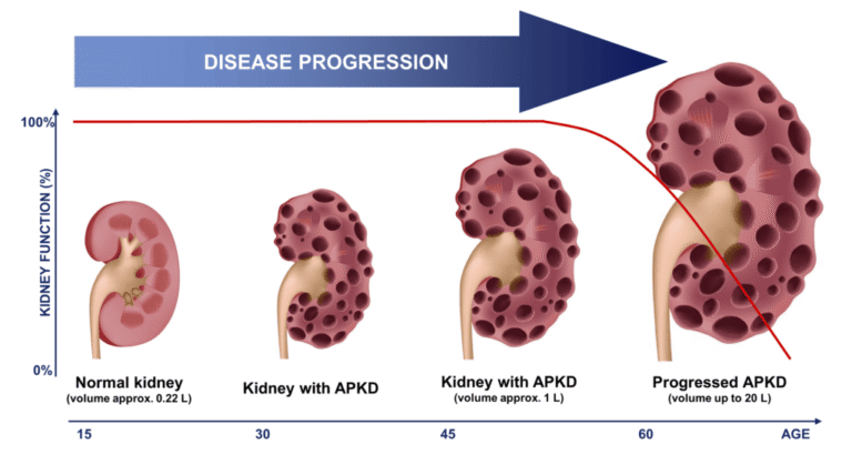 Polycystic Kidney Disease (PKD)