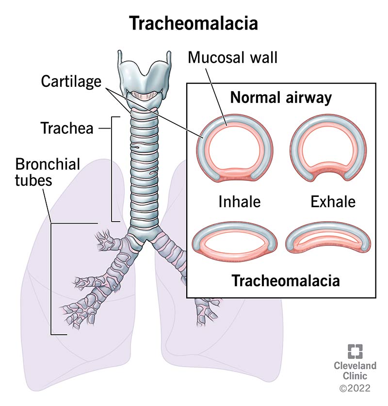 Tracheal Pathologies Diagram