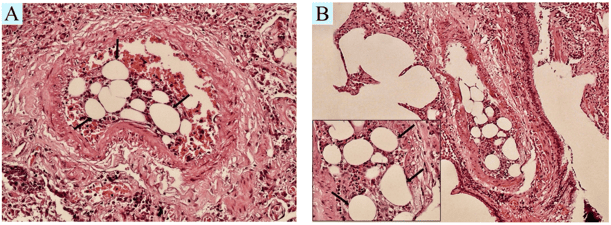 Embolism in Pathology