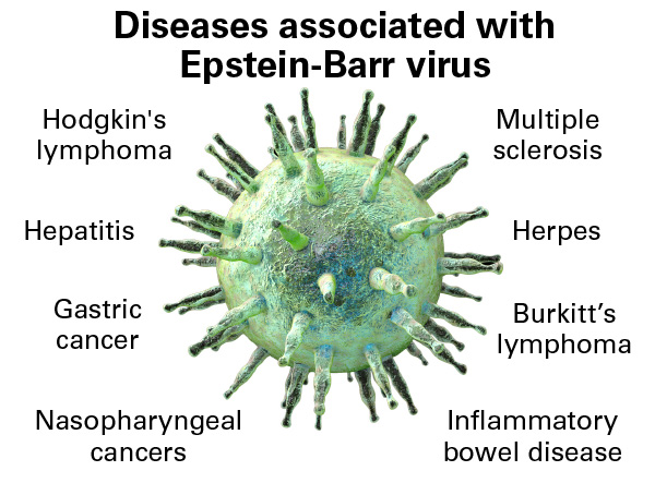 Epstein-Barr Virus (EBV)