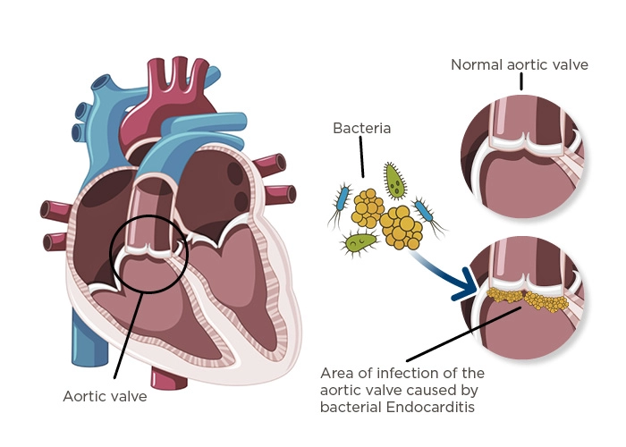 infective