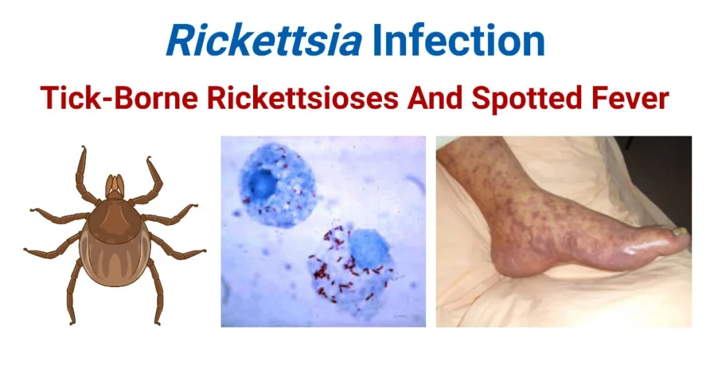 Rickettsiae, Spotted Fevers & Typhus
