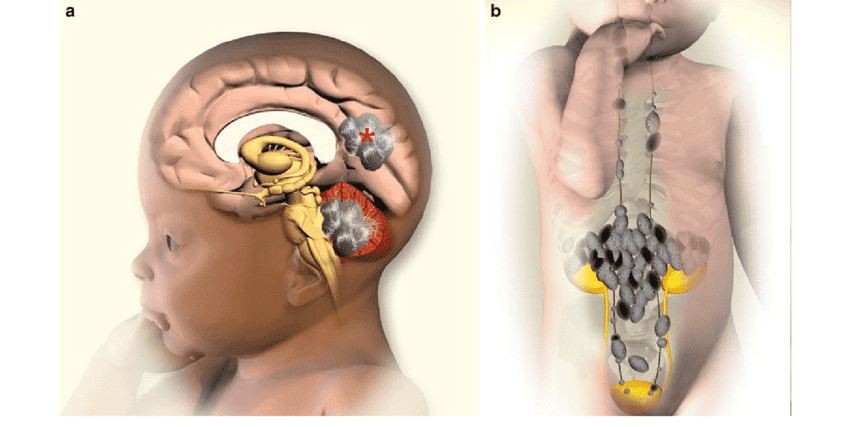 Brain Tumors and Neuroblastoma