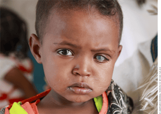 Congenital Glaucoma and Retinoblastoma