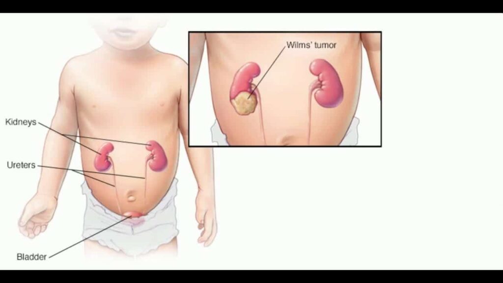 Wilms Tumor (Nephroblastoma)