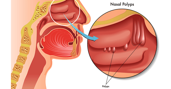 nasal polyps