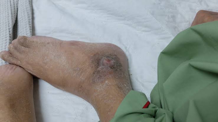 SKIN-RELATED CONDITIONS IN PALLIATIVE CARE