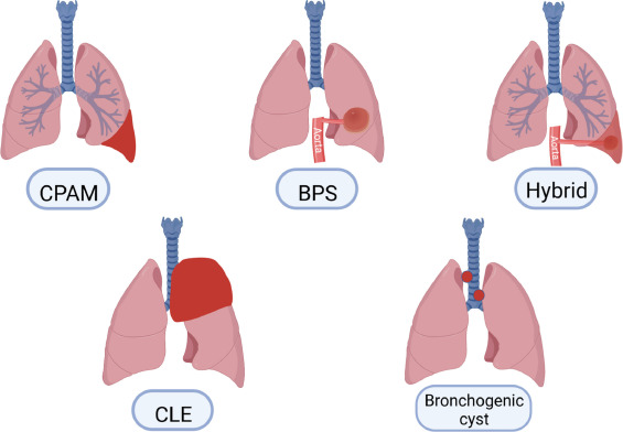 Congenital and Developmental Anomalies of the Lung