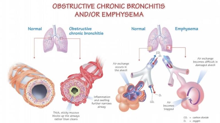 Pulmonary Function COPD Emphysema and Chronic Bronchitis (1)