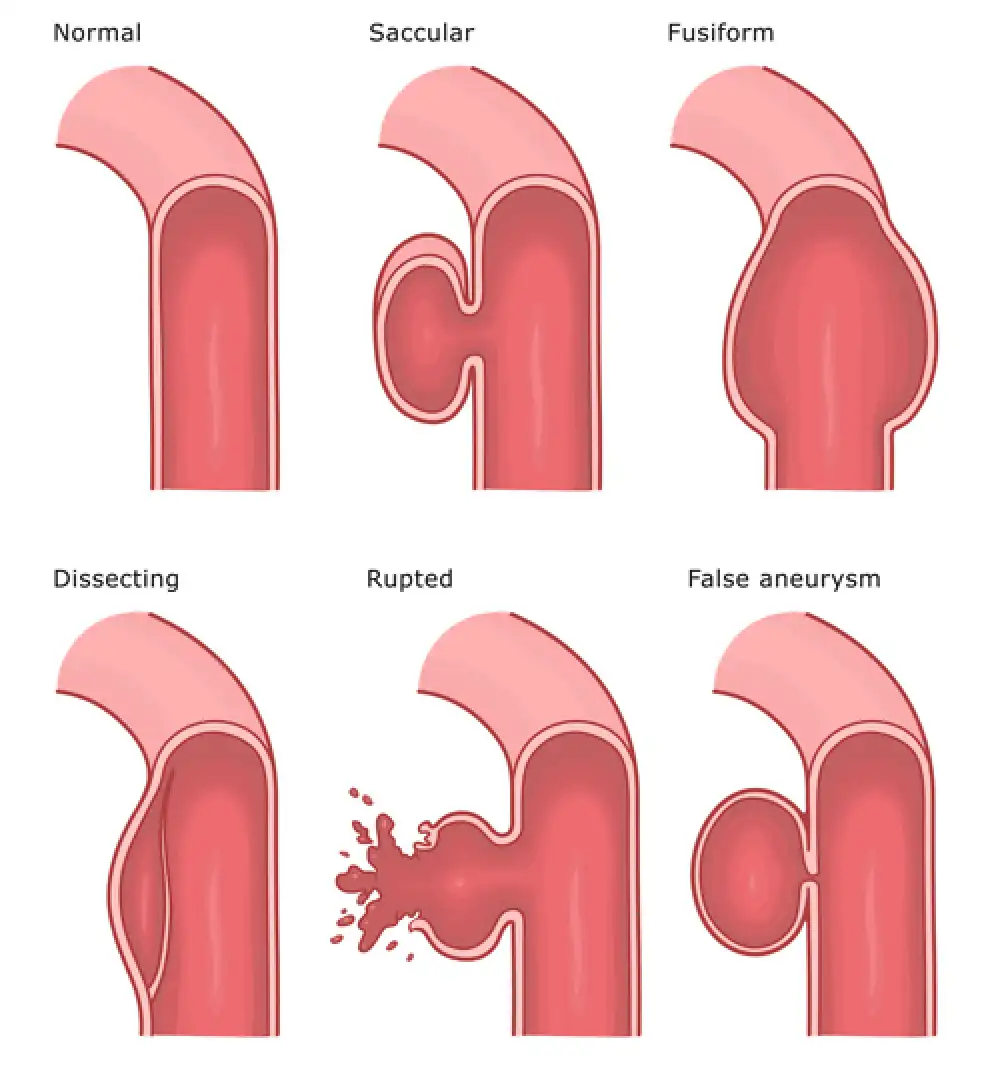 Aneurysms and Dissections and Vascular Disorders in Pathology